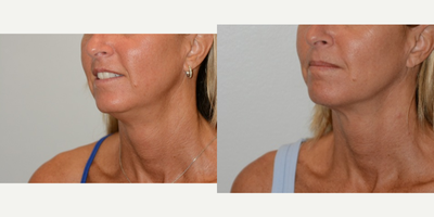 45-54 year old woman treated with Ultherapy - 51 year old patients treated with Ulthera