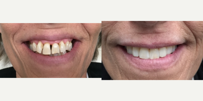 35-44 year old woman treated with Dental Bonding - A smile ruined by gum disease and large spaces between the teeth. Needed a cheaper option that veneers. After doing a digital smile enhancement and seeing whats possible with our virtual smile design, patient&nbsp;moved forward with her direct resin bondings. The whole procedure was completed in a single 45 min visit.