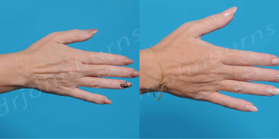 35-44 year old woman treated with Hand Rejuvenation - 1.5 Radiesse to each hand