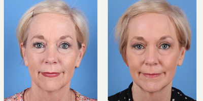 64 year old woman treated with Phenol Peel to full face - Dr.Sukkar performed a Phenol Peel to this 64 year old patient. Photos taken at 3 months post op.(281) 990-8487 | 14018 Aesthetic Circle Houston, TX 77062 | www.drsukkar.com