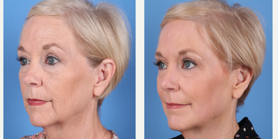 64 year old woman treated with Phenol Peel to full face - Dr.Sukkar performed a Phenol Peel to this 64 year old patient. Photos taken at 3 months post op.(281) 990-8487 | 14018 Aesthetic Circle Houston, TX 77062 | www.drsukkar.com