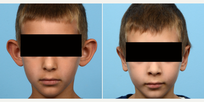 17 or under year old man treated with Ear Surgery - Dr. Wise performed an otoplasty on this 8-year-old patient to correct his protruding ears. 2 months post-op, the patient's ears are in a more natural position. The patient was so happy with his results and in his words thankful for Dr. Wise helping me with my ears!.
