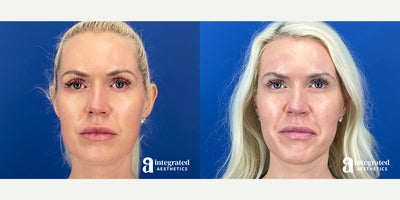 35-44 year old woman treated with Sculptra - The patient is a 37-year-old female with concerns about facial aging in the temples. To address these concerns, Dr. Climov treated the area with Sculptra. The after results are 2 months post-treatment.
