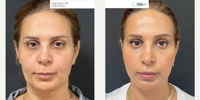 35-44 year old woman treated with Facelift - Facelift