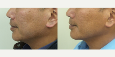 Man treated with Microneedling - Man treated with Microneedling
