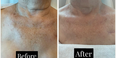 Woman treated with Lumecca - Woman treated with Lumecca