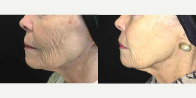 Woman treated with Microneedling - Woman treated with Microneedling using Vivace