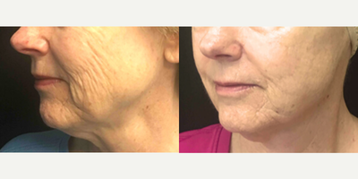 Woman treated with Microneedling - Woman treated with Microneedling to full face and neck