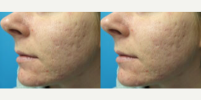 Woman treated with Microneedling - Woman treated with Microneedling using Vivace