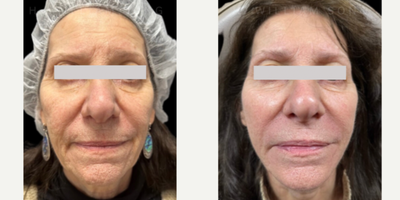 65-74 year old woman treated with PicoSure, PRF Treatment, PRP Injections - This wonderful client was treated with Autocorre PBF Gel, and one treatment of PicoSure laser.