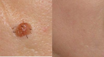 Mole Removal  - 
	Cosmetic mole removal
