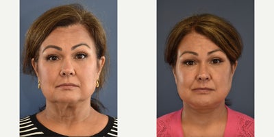Woman treated with Neck Lift - Woman treated with Neck Lift