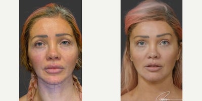 35-44 year old woman treated with Lip Surgery, Facial Fat Transfer, Brow Lift, Chin Liposuction - Tweaks detailsextended lateral dual plane brow lift. Fat transfer to tear troughs and other places for a permanent seamless transition from lower lid to cheek to lips (after getting rid of her previous filler).chin reduction for tapering and eradication of the witchs chinThe whole is greater than its individual parts.