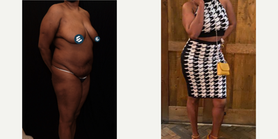 25-34 year old woman treated with Liposuction, Tummy Tuck, Brazilian Butt Lift, Botox for Hyperhidrosis - Liposuction, Tummy Tuck And Safe BBL