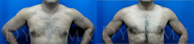 4D Lipo with fat transfer to pectorals - 	4D Lipo with fat transfer to pectorals