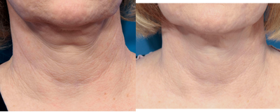 55-64 year old woman treated with Infini RF for neck lines - Patient desired improvement of neck lines and loose skin. This before and after is a one year result following 2 INFINI RF treatments.