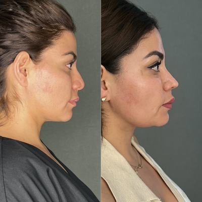 Structural Rhinoplasty - Rhinoplasty Blepharoplasty Anterior Necklift