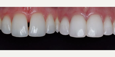 35-44 year old woman treated with Dental Bonding - Patient presented with a small diastema between her central teeth. Due to her shape and size of teeth, bonding was the best option for her to correct.&nbsp;