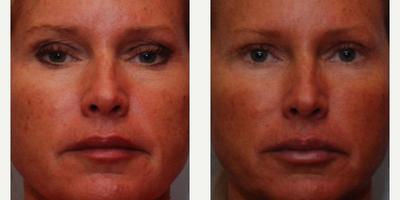 Woman treated with Juvederm - Injectable Fillers