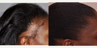 45-54 year old woman treated with Hair Transplant - Before and After photos of bonnet reconstruction hair restoration surgery performed by Dr. Ken Anderson on patient who suffered from traction alopecia due to years of damaging hair styles such as braids, extensions, corn rows and dreadlocks.