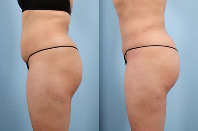 Woman treated with Liposuction - Woman treated with Liposuction on her abdomen, flanks, back, and thigh.