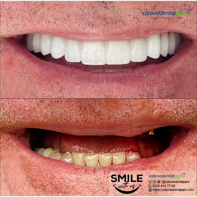 35-44 year old man treated with Dental Implants, Dental Crown, Full Mouth Reconstruction - We came to our Yalova Dental Park Dental Clinic due to missing teeth and gave our patients a new smile look and function with dental implants and digital zirconium.