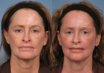 51 year old woman with sun damage treated with a Croton Oil/Phenol Peel - 51 year old woman with sun damage treated with a Croton Oil/Phenol Peel