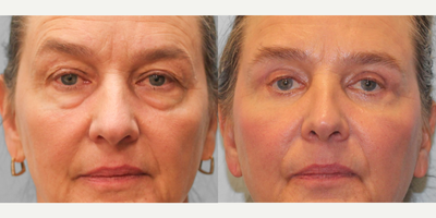 55-64 year old woman treated with Rhinoplasty - This woman in her early sixties came to see Dr. Howell for a blepharoplasty and rhinoplasty. She lost a significant amount of weight and had concerns about the loose skin around her eyes. After discussing with Dr. Howell, she chose to go with a closed rhinoplasty and upper and lower blepharoplasty. Since her surgery, she feels like she looks much more rested and refreshed and has been very happy with her results. She is pictured before and three months post-op.