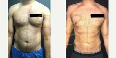 Man treated with Liposuction - Man treated with Liposuction