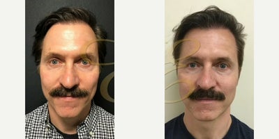 Man treated with Hair Transplant - Man treated with Hair Transplant