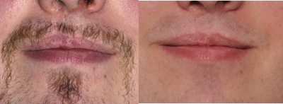 24 Year Old For Cleft Lip Scar Revision - cleft lip scar revision