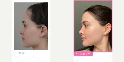 25-34 year old woman treated with V Line Surgery, Rhinoplasty - LA, Rh