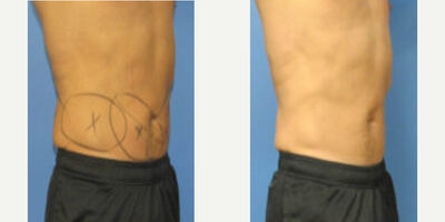 Man treated with CoolTone, CoolSculpting - Man treated with CoolTone, CoolSculpting