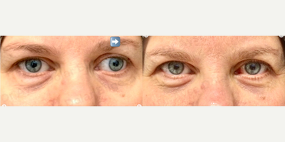 Woman treated with Strabismus Surgery - Woman treated with Strabismus Surgery