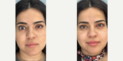 Woman treated with Eyelid Surgery, Ptosis Surgery - Woman treated with Eyelid Surgery, Ptosis Surgery
