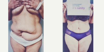 35-44 year old woman treated with Liposuction - Our patient had a couple of abdominal surgeries which in the end left her with deformities. Other than distorted anatomy, she also had excess fat and sagging skin which she wanted to get corrected as well! We performed 360 liposuction, and abdominoplasty along with neo navel creation with the restoration of normal anatomy.Both us and our patient are very happy seeing her 6 weeks results. She says Doc, u made me fall in love myself again! #transforminglives