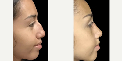 Woman treated with Rhinoplasty - Dr. Wolf's precision in rhinoplasty has delivered a refined and professional aesthetic. Explore the art of transformative surgery.