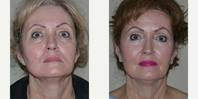 63 year old woman treated with Silhouette InstaLift - 63 year old woman treated with Silhouette InstaLift to cheeks, shown 1 year post op. She also had PDO Threads around the corners of her mouth as well as Facial Fat Transfer to her temporal areas, cheeks, infra orbital/tear troughs, and to her upper eyelid hollows. Post op, she had fuller cheeks, softer cheek curves, softer lower lid-cheek junction, and better defined angle of her jaw.