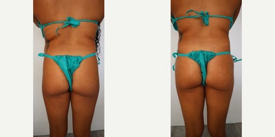25-34 year old woman treated with Sculptra - Sculptra, 5 vials per side buttocks enhacement