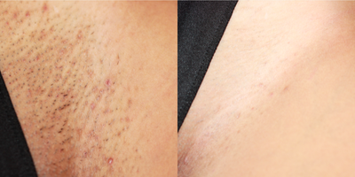 25-34 year old woman treated with Laser Hair Removal - Laser hair removal at bikini line