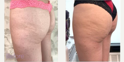 Woman treated with Sculptra Butt Lift - Woman treated with Sculptra Butt Lift.