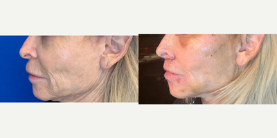 55-64 year old woman treated with Lip Lift Surgery, Threads, and Filler - Patient had liplift surgery, blepharoplasty (not show in these photos but bruising is evident), threads and fillers to cheeks. Photos are one week post-surgery. Sutures are not yet removed.