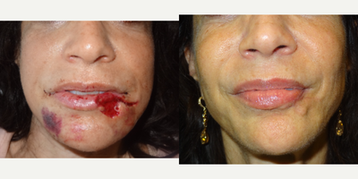45-54 year old woman treated with Lip Surgery/Reconstruction after dog bite injury - This patient lost 25% of her lower lip from a dog bite injury. A complex reconstruction was performed to realign her lip muscles and borders, provide bulk and symmetry. She is recovering well 3 months after the procedure. She has no issues pursing her lips, chewing on food or drinking liquids. The goal of reconstruction to restore normal function and obtain good cosmesis.