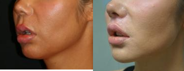 Lip Augmentation - Lip Augmentation