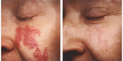 Woman treated with Pulsed Dye Laser - Woman treated with Pulsed Dye Laser