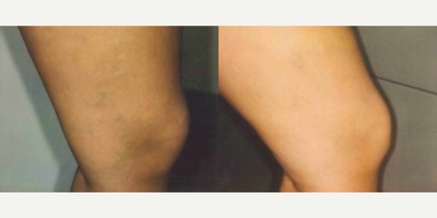 Woman treated with Pulsed Dye Laser - Woman treated with Pulsed Dye Laser