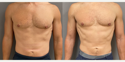 35-44 year old man treated with Gynecomastia Surgery - 36 yo male s/p gynecomastia liposuction with excision performed under local anesthesia with sedation in our on site AAA certified operating suite.