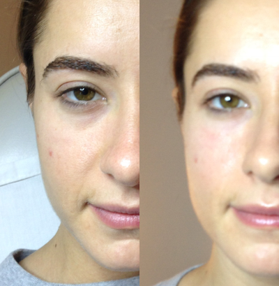 25-34 year old woman treated with Injectable Fillers - Undereye treatment with Redensity 2 injectable filler. Non-surgical Results are immediate. Minimal downtime No pain