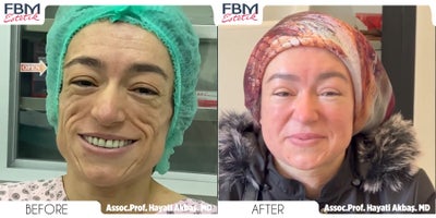 35-44 year old woman treated with Facial Fat Transfer - 35-44 year old woman treated with Facial Fat Transfer