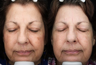 55-64 year old woman treated with BroadBand Light (BBL) - Patient received 1 BBL treatment.